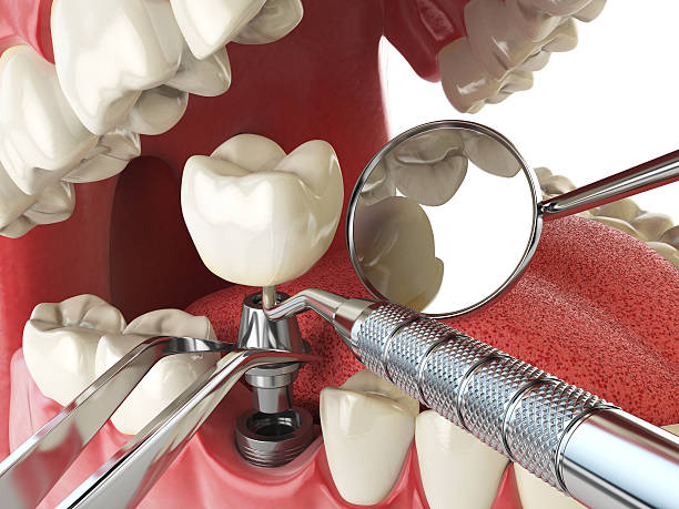 Best Knocked-Out Tooth (Avulsed Tooth) Treatment in Vla Grove, IL